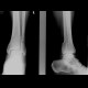 Bimalleolar ankle fracture with abruption of the posterior edge of tibia: X-ray - Plain radiograph
